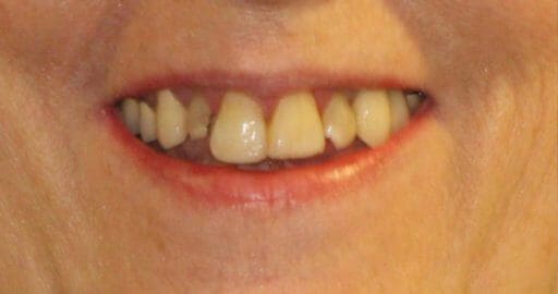 Teeth 4 Before Maple Avenue Family Dentistry