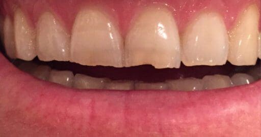 Teeth 5 Before Maple Avenue Family Dentistry