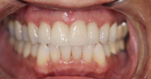 Teeth-1-After Teeth-1-After