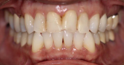 Teeth-1-Before Teeth-1-Before