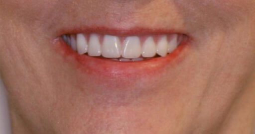 Teeth-4-After Teeth-4-After
