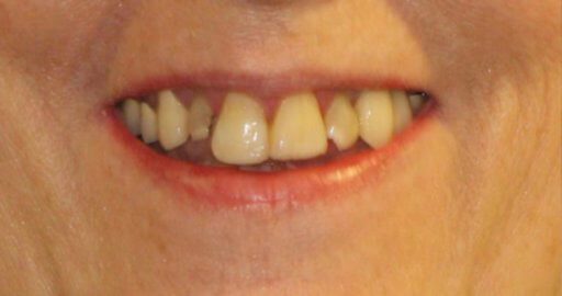 Teeth-4-Before Teeth-4-Before
