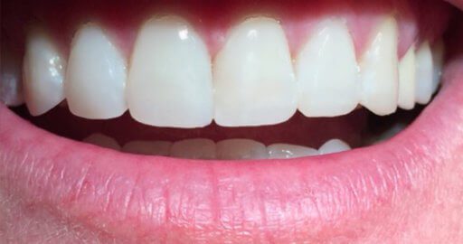 Teeth-5-After Teeth-5-After