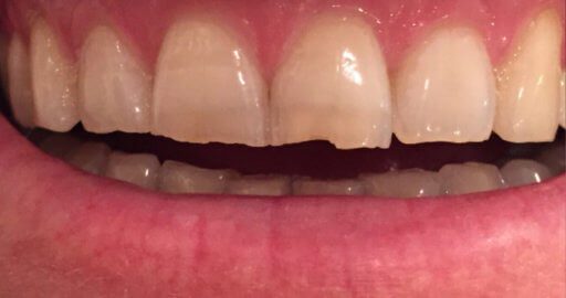 Teeth-5-Before Teeth-5-Before