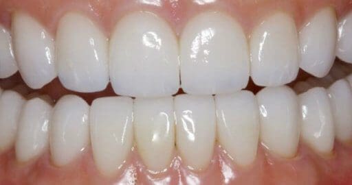 Teeth-3-After Teeth-3-After
