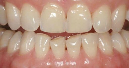 Teeth-3-Before Teeth-3-Before