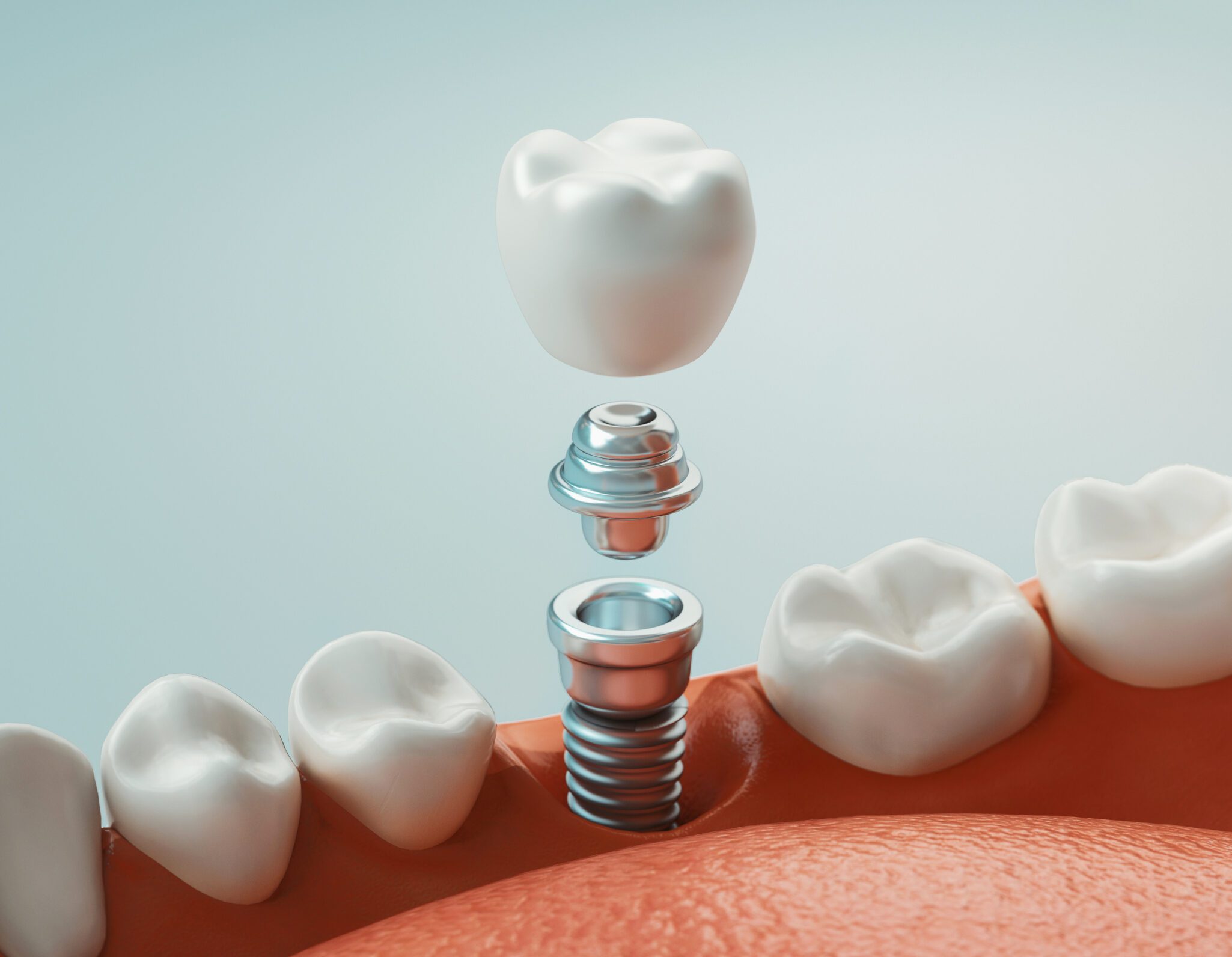 implant-supported crowns implant restoration dental implants Barrington dental implants Warren RI